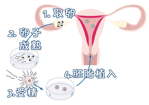 女人代怀试管